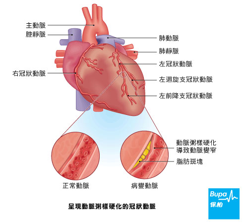 heart attack_atherosclerosis-chi